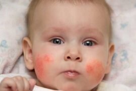Home remedies for baby rash on body and face